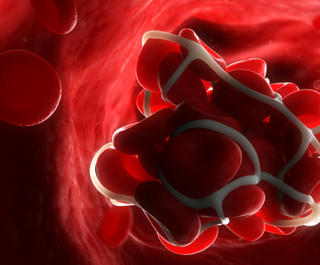 A computerised render of a blood clot in the bloodstream